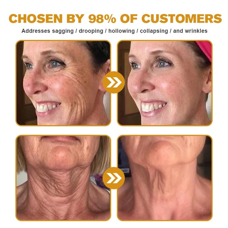 Botox Bee Venom Cream